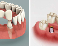Dantų protezavimas pas patyrusius odontologus